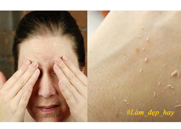 Để mặt không khô sần, bạn nhất định phải nằm lòng 7 bí quyết chăm sóc da mùa đông này