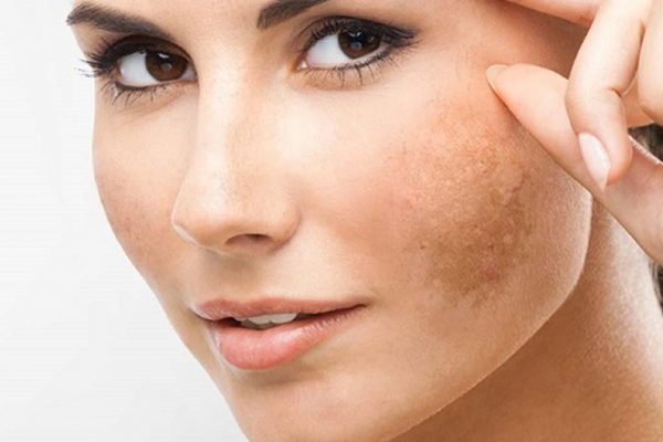 Bí quyết trị nám da cho chị em phụ nữ Bí quyết trị nám da cho chị em phụ nữ