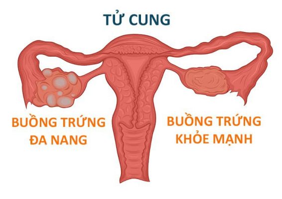 * Đa nang buồng trứng * Đa nang buồng trứng