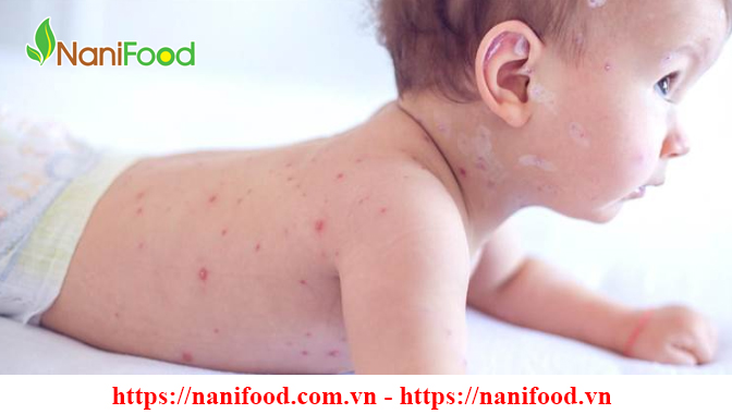 Bệnh Sởi - Những bệnh thường gặp vào mùa hè mọi người cần lưu ý Bệnh Sởi - Những bệnh thường gặp vào mùa hè mọi người cần lưu ý