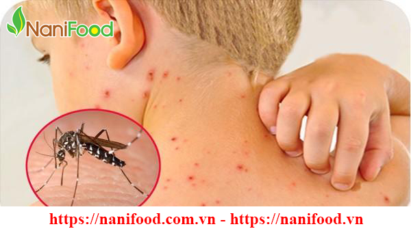 Sốt Xuất Huyết - Những bệnh thường gặp vào mùa hè mọi người cần lưu ý Sốt Xuất Huyết - Những bệnh thường gặp vào mùa hè mọi người cần lưu ý