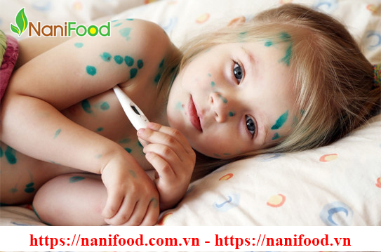 Bệnh Thủy Đậu - Những bệnh thường gặp vào mùa hè mọi người cần lưu ý Bệnh Thủy Đậu - Những bệnh thường gặp vào mùa hè mọi người cần lưu ý